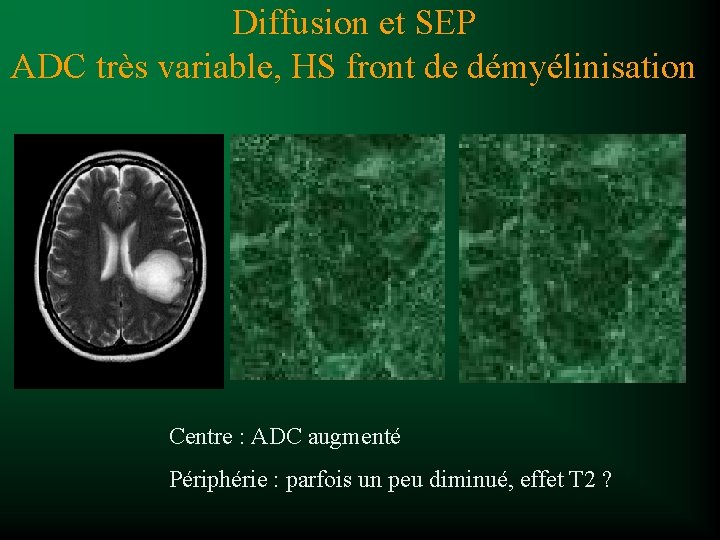 Diffusion et SEP ADC très variable, HS front de démyélinisation Centre : ADC augmenté
