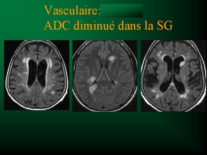 Vasculaire ou SEP Vasculaire: ADC diminué dans la SG 