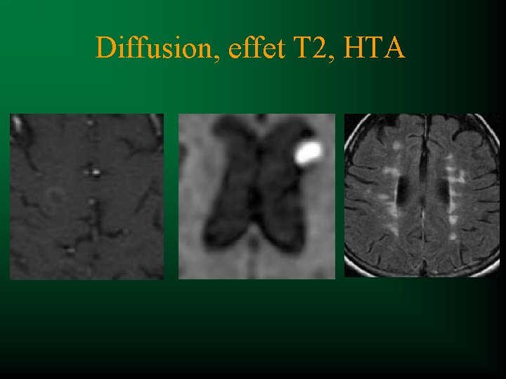 Diffusion, effet T 2, HTA 