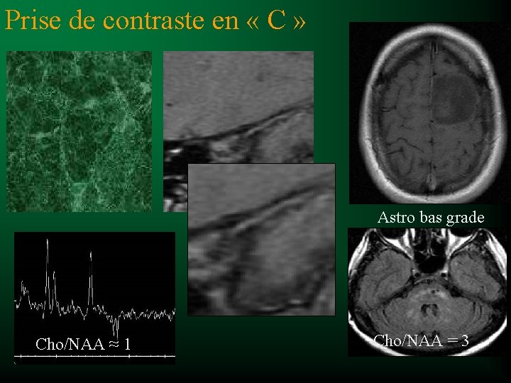 Prise de contraste en « C » Astro bas grade Cho/NAA ≈ 1 Cho/NAA
