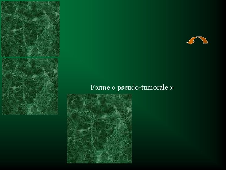 Forme « pseudo-tumorale » 