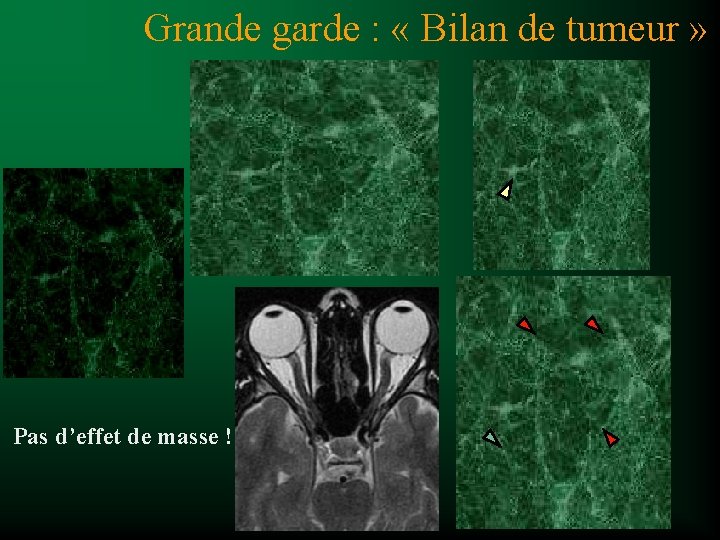 Grande garde : « Bilan de tumeur » Pas d’effet de masse ! 