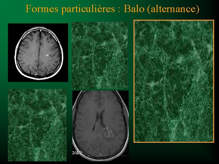 Formes particulières : Balo (alternance) 