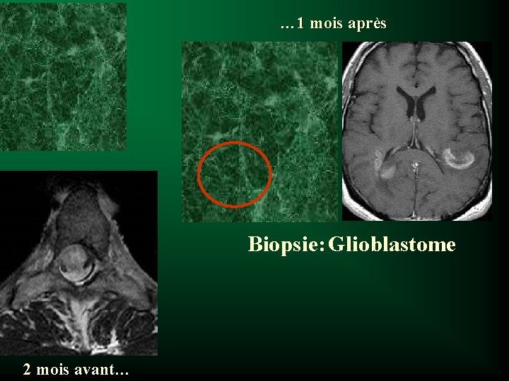 … 1 mois après Biopsie: Glioblastome 2 mois avant… 