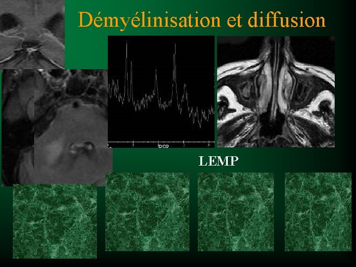 Démyélinisation et diffusion LEMP 