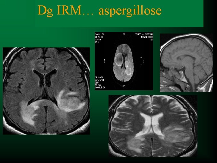 Dg IRM… aspergillose Dg clinique NO … 
