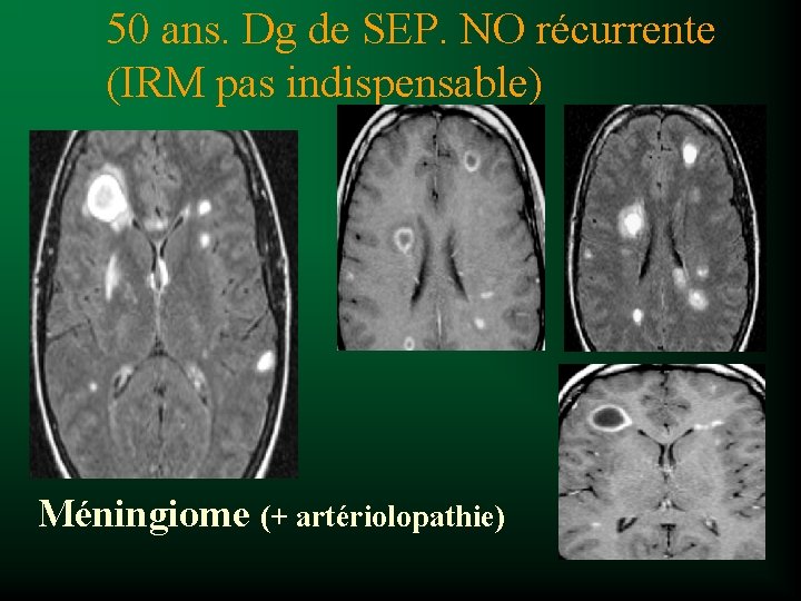 50 ans. Dg de SEP. NO récurrente (IRM pas indispensable) Méningiome (+ artériolopathie) 