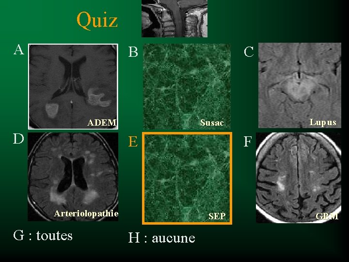 Quiz A B ADEM D C E Arteriolopathie G : toutes Lupus Susac F
