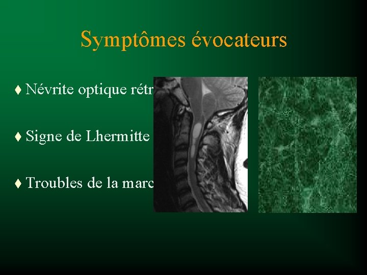 Symptômes évocateurs t Névrite optique rétrobulbaire t Signe de Lhermitte t Troubles de la