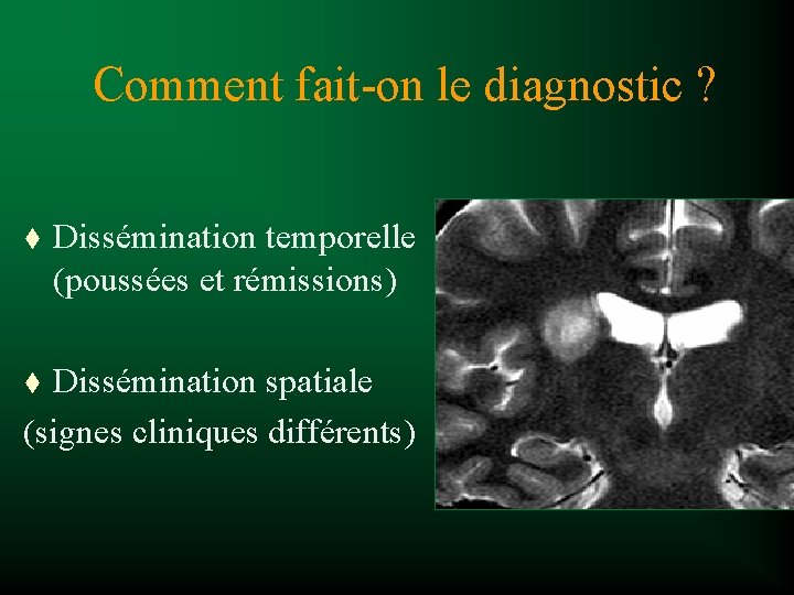 Comment fait-on le diagnostic ? t Dissémination temporelle (poussées et rémissions) Dissémination spatiale (signes