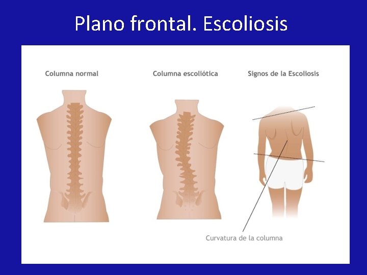 Plano frontal. Escoliosis Plano frontal. Escoliosis