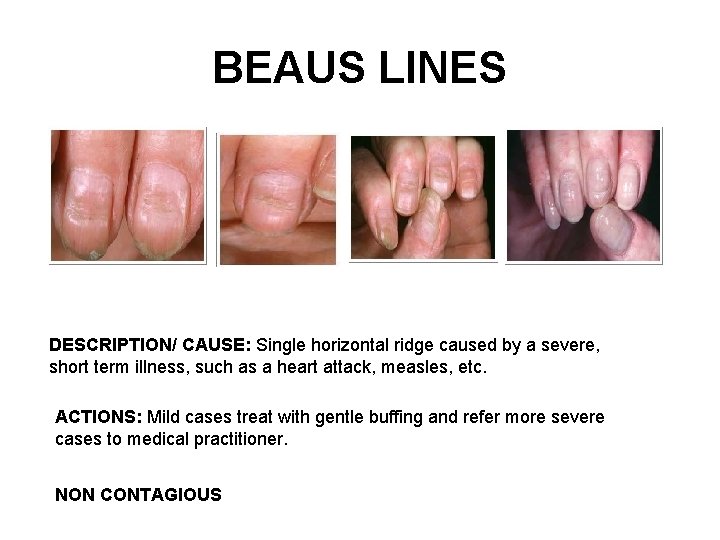 BEAUS LINES DESCRIPTION/ CAUSE: Single horizontal ridge caused by a severe, short term illness,