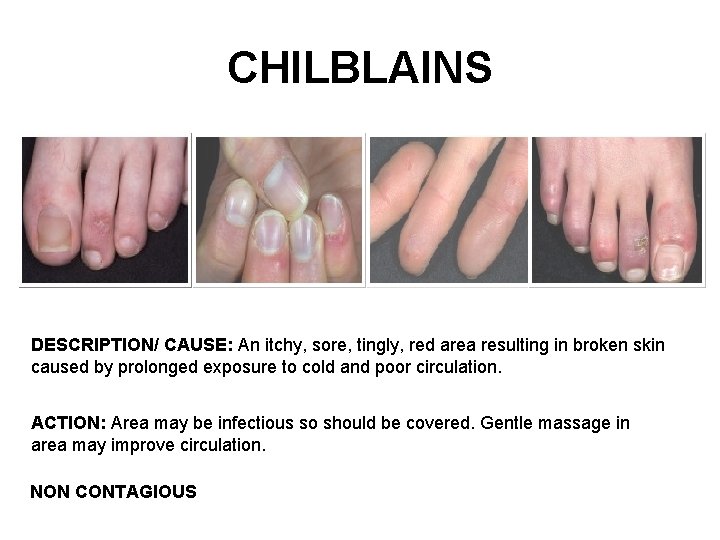 CHILBLAINS DESCRIPTION/ CAUSE: An itchy, sore, tingly, red area resulting in broken skin caused