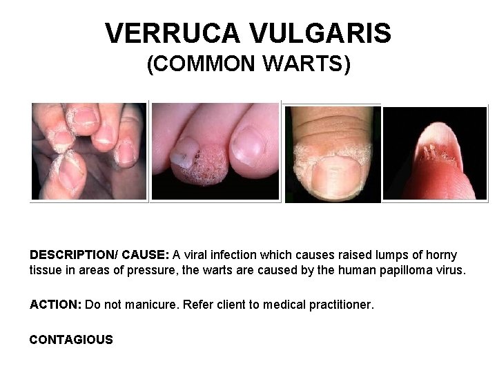 VERRUCA VULGARIS (COMMON WARTS) DESCRIPTION/ CAUSE: A viral infection which causes raised lumps of