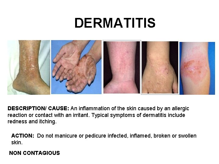 DERMATITIS DESCRIPTION/ CAUSE: An inflammation of the skin caused by an allergic reaction or