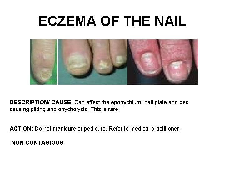 ECZEMA OF THE NAIL DESCRIPTION/ CAUSE: Can affect the eponychium, nail plate and bed,