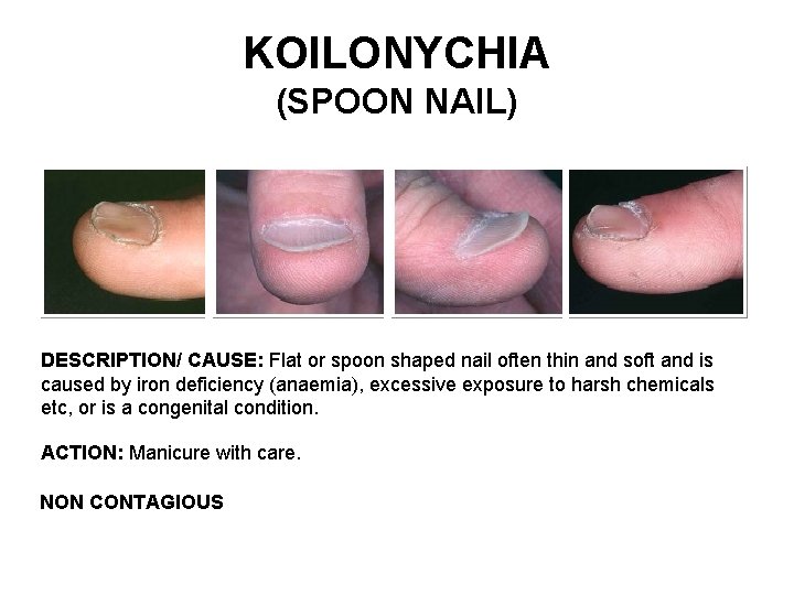 KOILONYCHIA (SPOON NAIL) DESCRIPTION/ CAUSE: Flat or spoon shaped nail often thin and soft