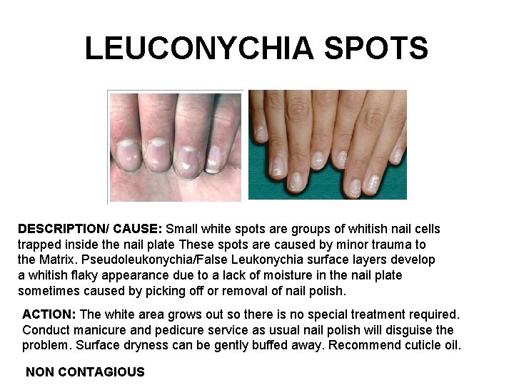 LEUCONYCHIA SPOTS DESCRIPTION/ CAUSE: Small white spots are groups of whitish nail cells trapped