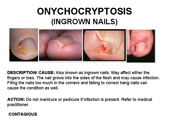 ONYCHOCRYPTOSIS (INGROWN NAILS) DESCRIPTION/ CAUSE: Also known as ingrown nails. May affect either the