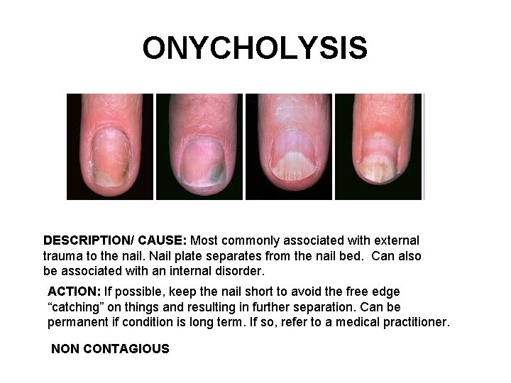 ONYCHOLYSIS DESCRIPTION/ CAUSE: Most commonly associated with external trauma to the nail. Nail plate