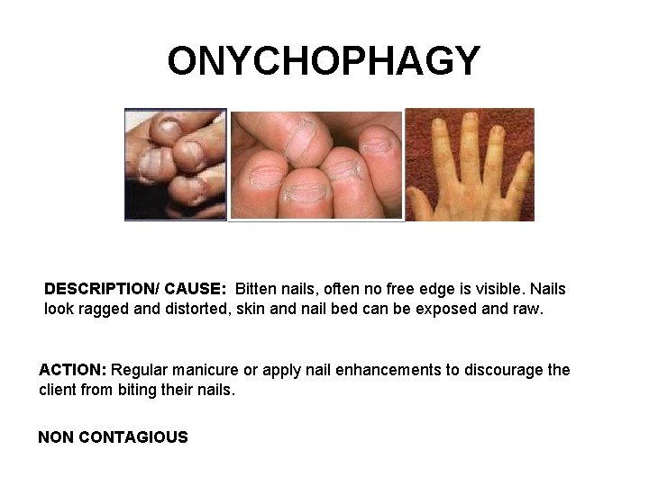 ONYCHOPHAGY DESCRIPTION/ CAUSE: Bitten nails, often no free edge is visible. Nails look ragged