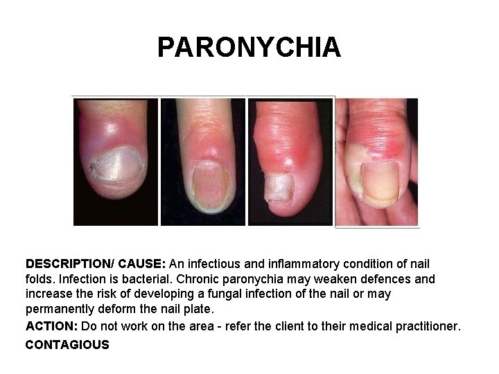 PARONYCHIA DESCRIPTION/ CAUSE: An infectious and inflammatory condition of nail folds. Infection is bacterial.