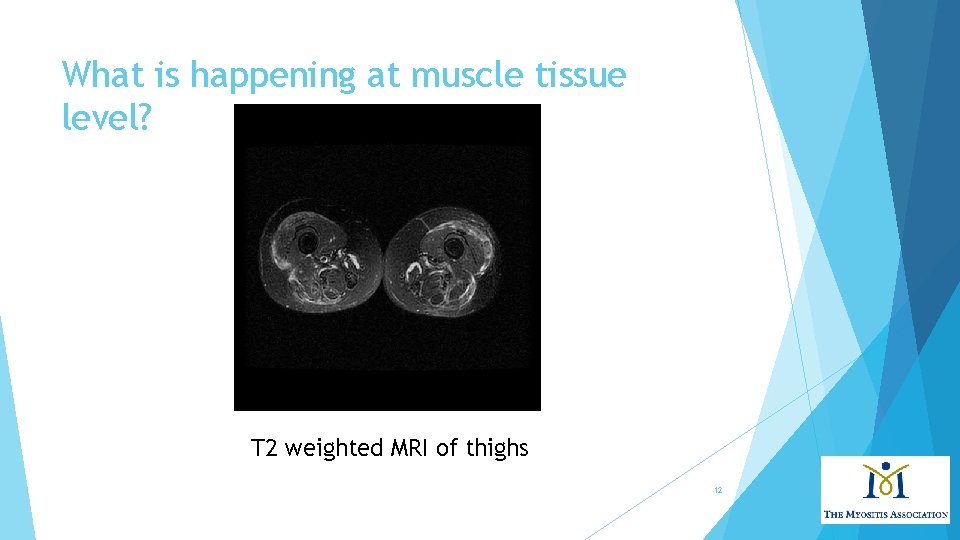 What is happening at muscle tissue level? T 2 weighted MRI of thighs 12