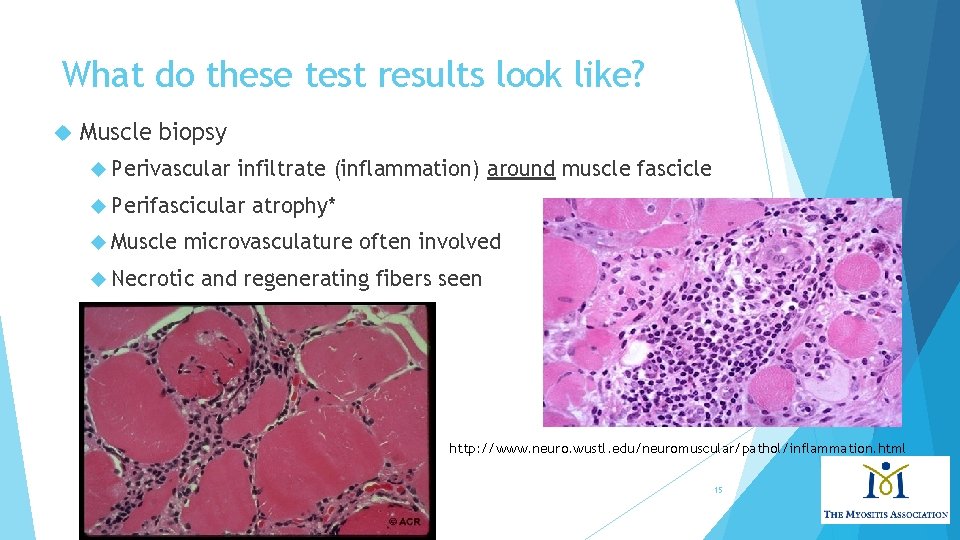What do these test results look like? Muscle biopsy Perivascular infiltrate (inflammation) around muscle