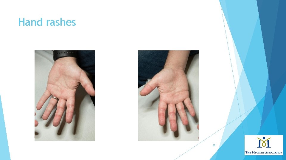 Hand rashes 20 