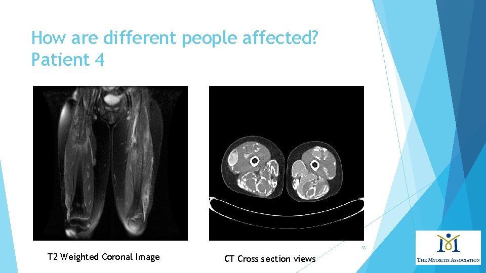 How are different people affected? Patient 4 33 T 2 Weighted Coronal Image CT