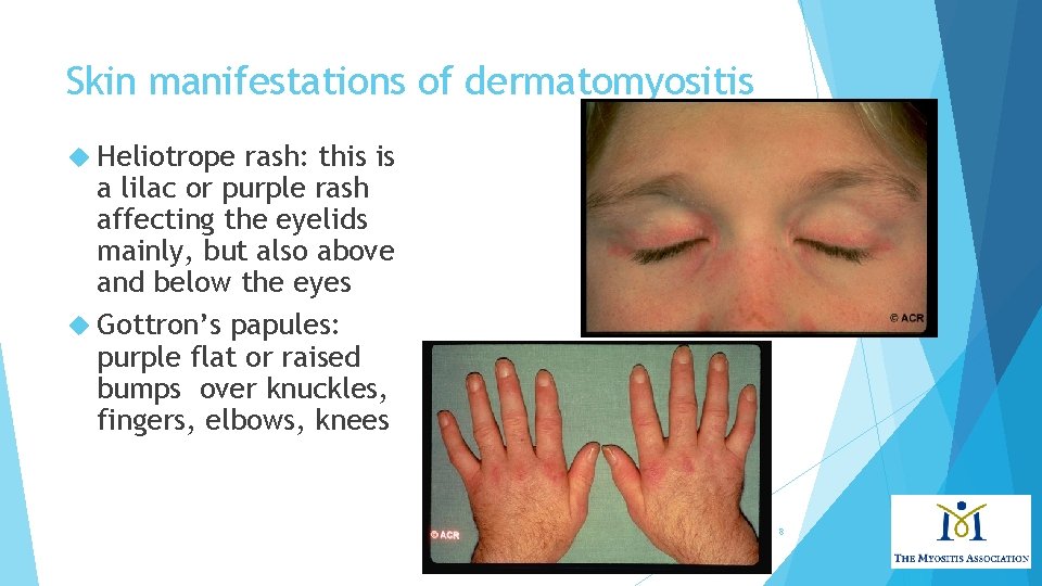 Skin manifestations of dermatomyositis Heliotrope rash: this is a lilac or purple rash affecting