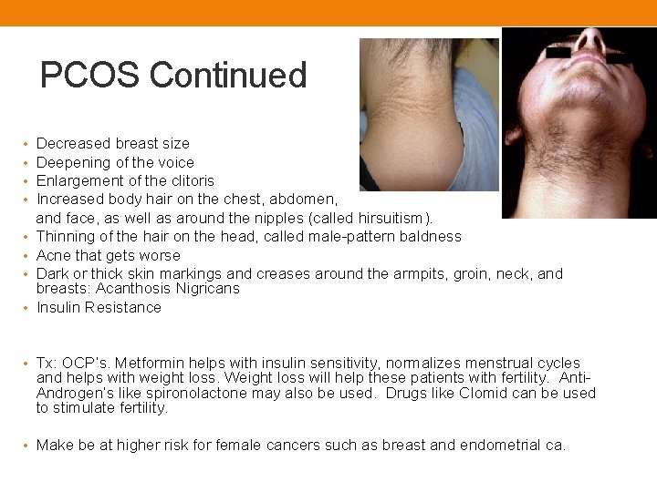 PCOS Continued Decreased breast size Deepening of the voice Enlargement of ...