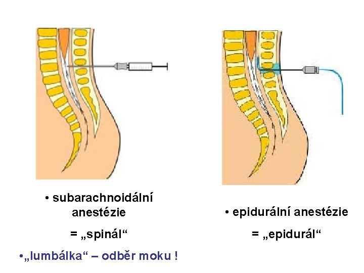  • subarachnoidální anestézie • epidurální anestézie = „spinál“ = „epidurál“ • „lumbálka“ –