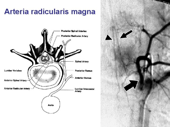Arteria radicularis magna 