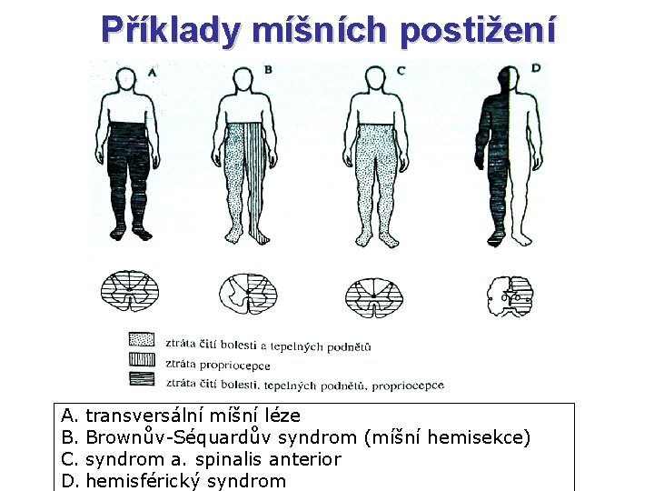 Příklady míšních postižení A. transversální míšní léze B. Brownův-Séquardův syndrom (míšní hemisekce) C. syndrom