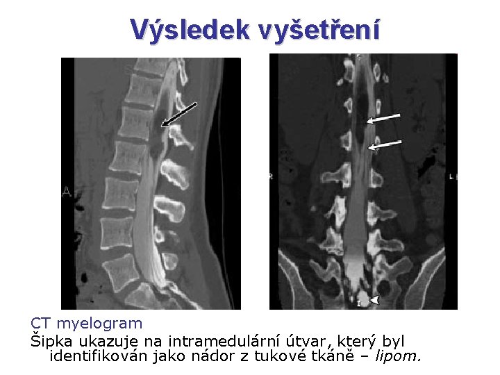 Výsledek vyšetření CT myelogram Šipka ukazuje na intramedulární útvar, který byl identifikován jako nádor