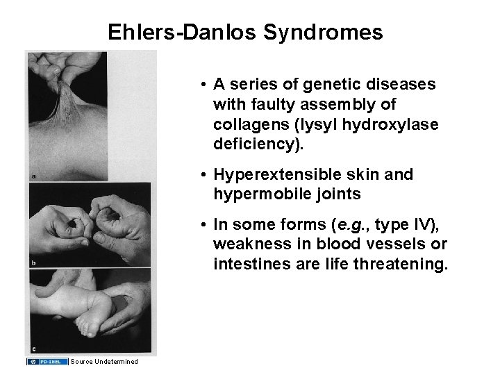 Ehlers-Danlos Syndromes • A series of genetic diseases with faulty assembly of collagens (lysyl