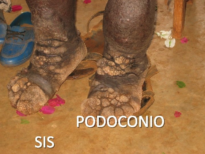 What is Podoconiosis? - 1 • Non-infectious elephantiasis (“swelling of limb like an elephant’s”)