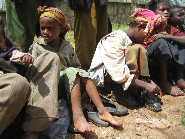 What is Podoconiosis? - 1 Non-infectious elephantiasis (“swelling of limb like an elephant’s”) caused