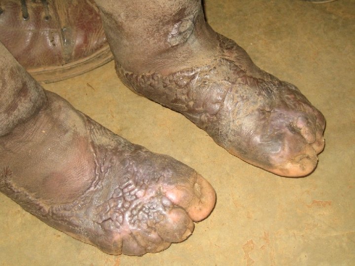 Simple Treatment is Effective Before After 