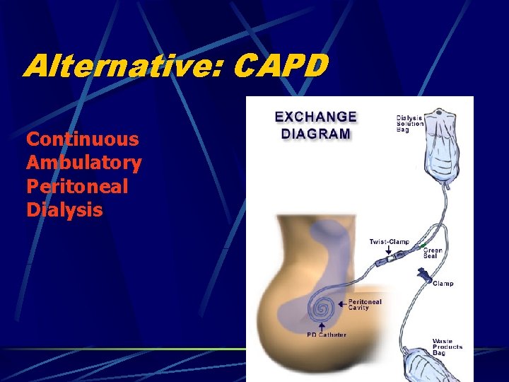 Alternative: CAPD Continuous Ambulatory Peritoneal Dialysis 