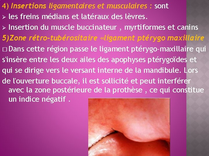 4) Insertions ligamentaires et musculaires : sont Ø les freins médians et latéraux des