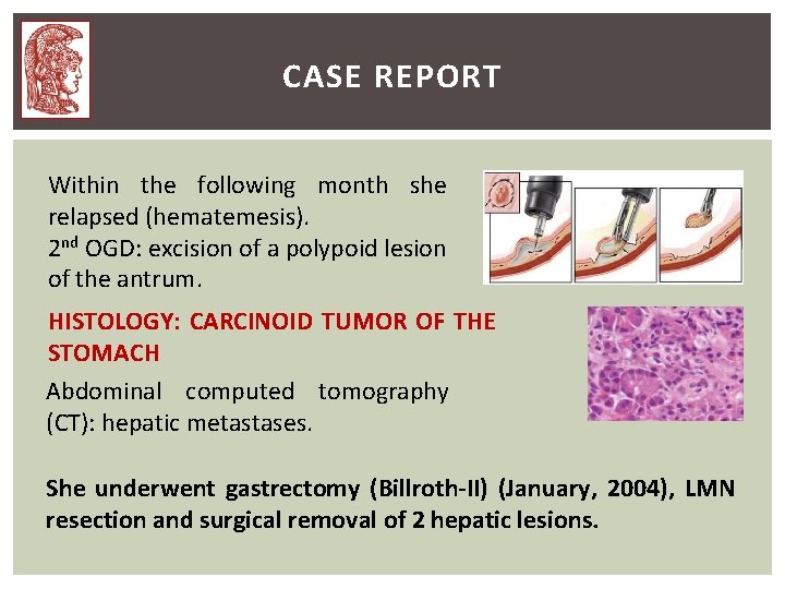 CASE REPORT Within the following month she relapsed (hematemesis). 2 nd OGD: excision of CASE REPORT Within the following month she relapsed (hematemesis). 2 nd OGD: excision of