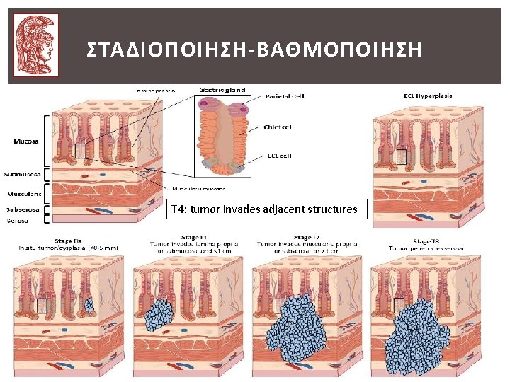 ΣΤΑΔΙΟΠΟΙΗΣΗ-ΒΑΘΜΟΠΟΙΗΣΗ T 4: tumor invades adjacent structures ΣΤΑΔΙΟΠΟΙΗΣΗ-ΒΑΘΜΟΠΟΙΗΣΗ T 4: tumor invades adjacent structures