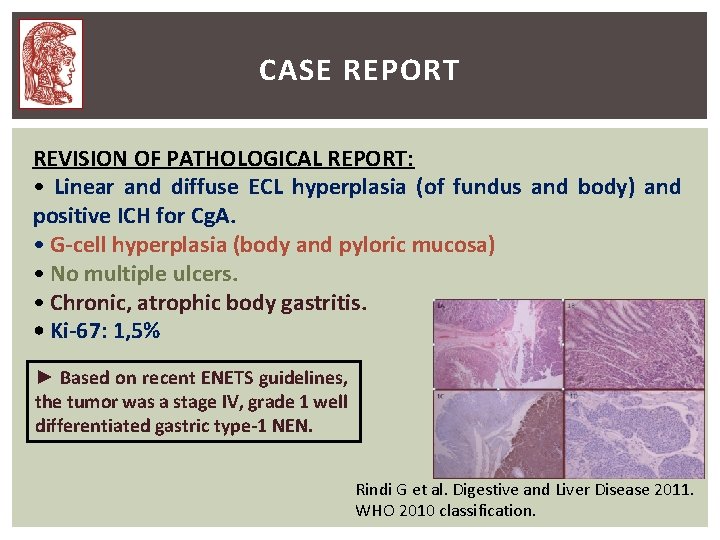 CASE REPORT REVISION OF PATHOLOGICAL REPORT: • Linear and diffuse ECL hyperplasia (of fundus CASE REPORT REVISION OF PATHOLOGICAL REPORT: • Linear and diffuse ECL hyperplasia (of fundus