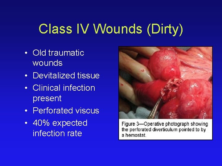 Class IV Wounds (Dirty) • Old traumatic wounds • Devitalized tissue • Clinical infection