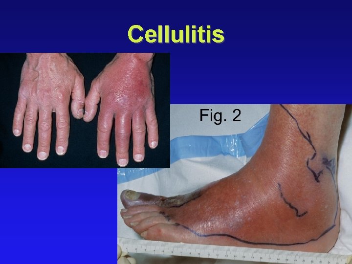 Cellulitis 