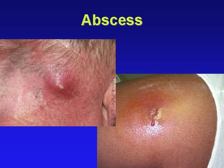 Abscess 