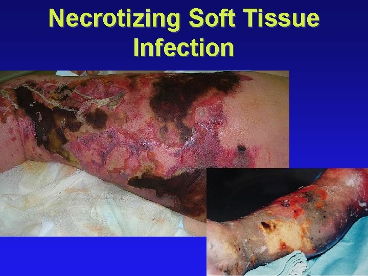 Necrotizing Soft Tissue Infection 