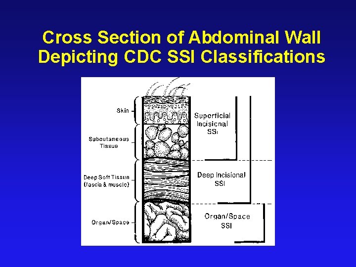 Cross Section of Abdominal Wall Depicting CDC SSI Classifications 